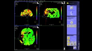 syngo-volume-perfusion-ct-neuro-video-screenshot-00070646~10