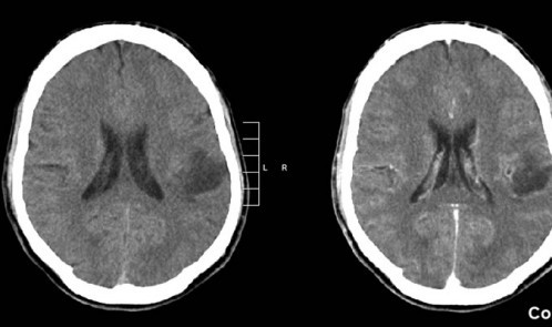 glioma-brain-scan