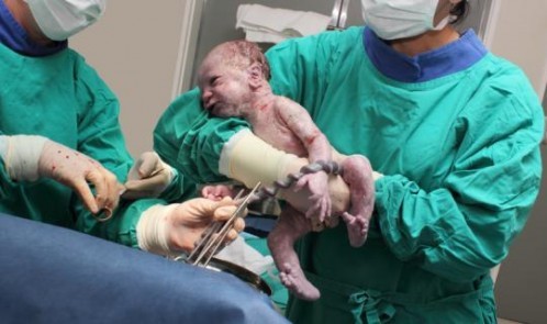 newborn-baby-having-its-cord-cut