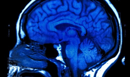 magnetic resonance image (MRI) of the brain