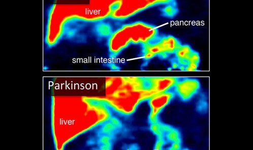 ht_150622_control_and_parkinson_650