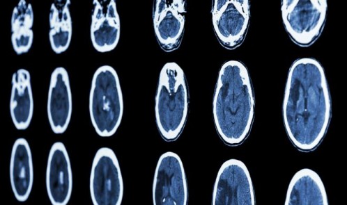 intracranial-hemorrhage