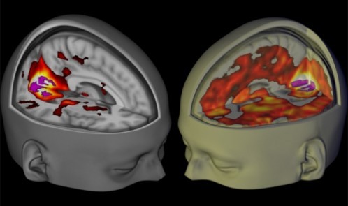 قشر بینایی مغز تحت تأثیر LSD نسبت به زمانی که تحت تأثیر دارونما تصویربرداری شده است ارتباطاتش را با دیگر مناطق مغزی افزایش داده است (تصیر سمت راست).