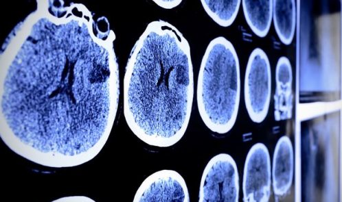 brain-scan