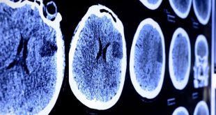 بهبود آثار سکته مغزی با داروی جدید