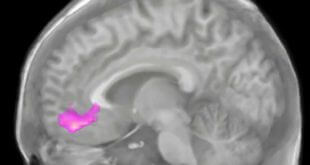 تصویربرداری مغزی