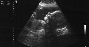 سونوگرافی دوران بارداری