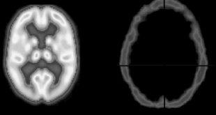 تفاوت متابولیزم مغز سالم و مرگ مغزی
